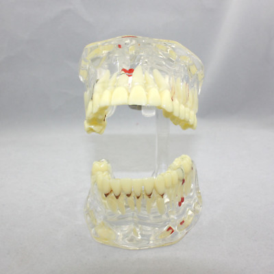 New Dental Study Tooth Transparent Adult Implant Pathological Teeth Model Sale
